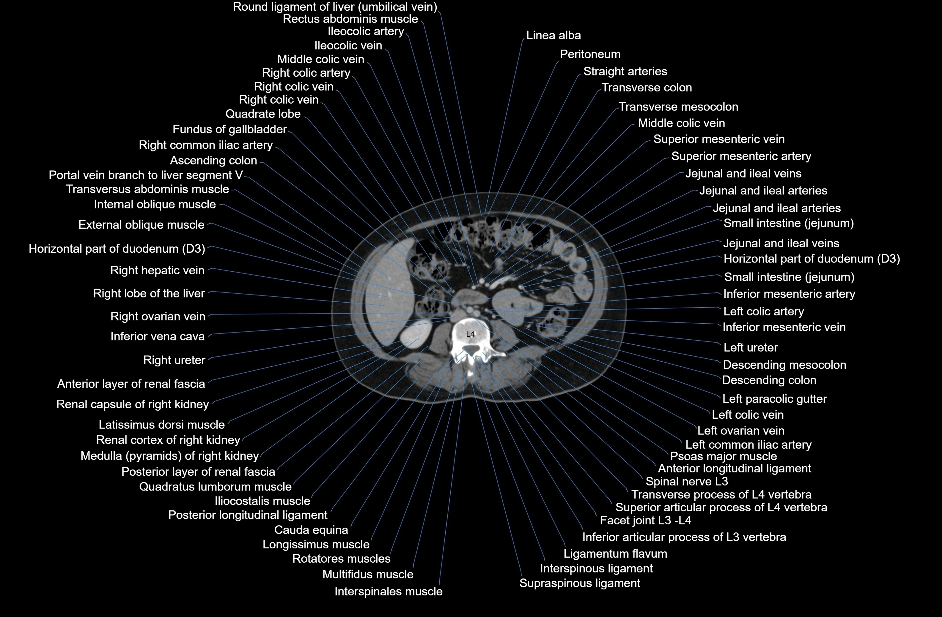 CT Abdomen axial cross sectional anatomy labelled radiology image-00049.webp
